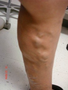 Varicose Veins Treatments | Spider Veins Treatments | Chicago | Naperville | Schaumburg