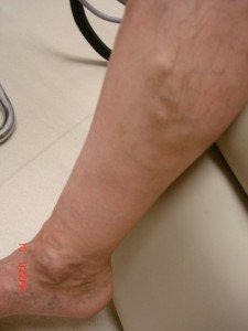 Varicose Veins Treatments | Spider Veins Treatments | Chicago | Naperville | Schaumburg
