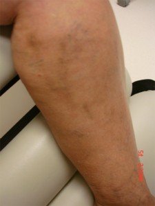 Varicose Veins Treatments | Spider Veins Treatments | Chicago | Naperville | Schaumburg