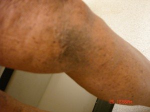 Varicose Veins Treatments | Spider Veins Treatments | Chicago | Naperville | Schaumburg