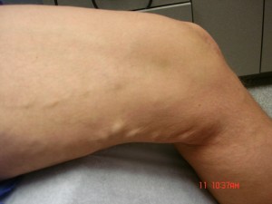 Varicose Veins Treatments | Spider Veins Treatments | Chicago | Naperville | Schaumburg