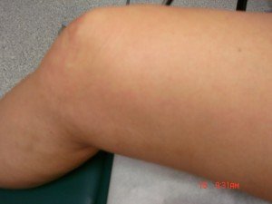 Varicose Veins Treatments | Spider Veins Treatments | Chicago | Naperville | Schaumburg