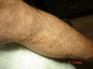 Varicose Veins Treatments | Spider Veins Treatments | Chicago | Naperville | Schaumburg