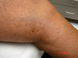 Varicose Veins Treatments | Spider Veins Treatments | Chicago | Naperville | Schaumburg