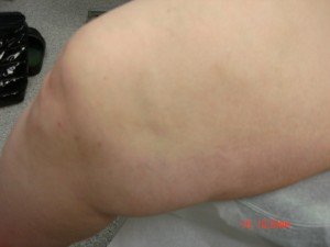 Varicose Veins Treatments | Spider Veins Treatments | Chicago | Naperville | Schaumburg